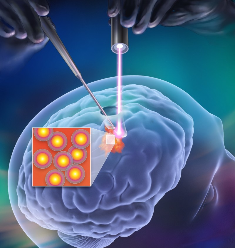 Neurocirujanos emplean lásers para ‘freír’ tumores cerebrales