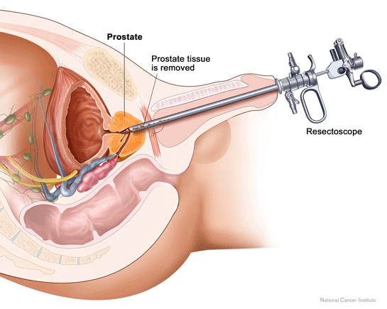 prevención del cáncer de próstata