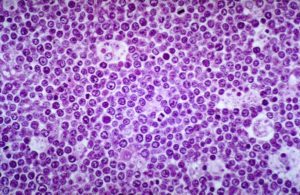 linfoma