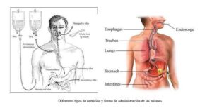 malnutrici&oacute;n-nutrición parenteral-enteral