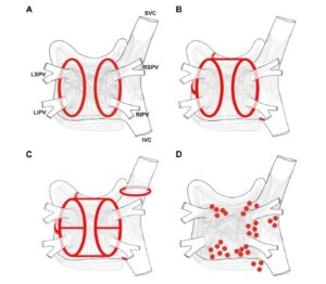 ablación-fibrilación auricular