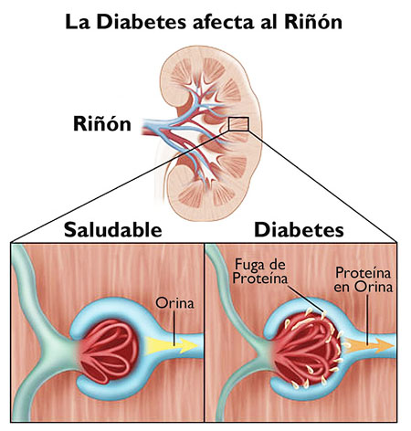 diabetes nefropatía crónica)