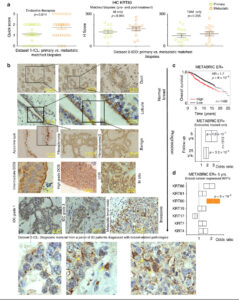 estudio-CSIC-proceso-tumoral-cáncer-de-mama-agresivo