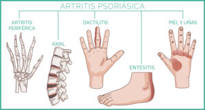 artritis-psoriásica 