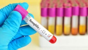 hemofilia-b-tratamiento