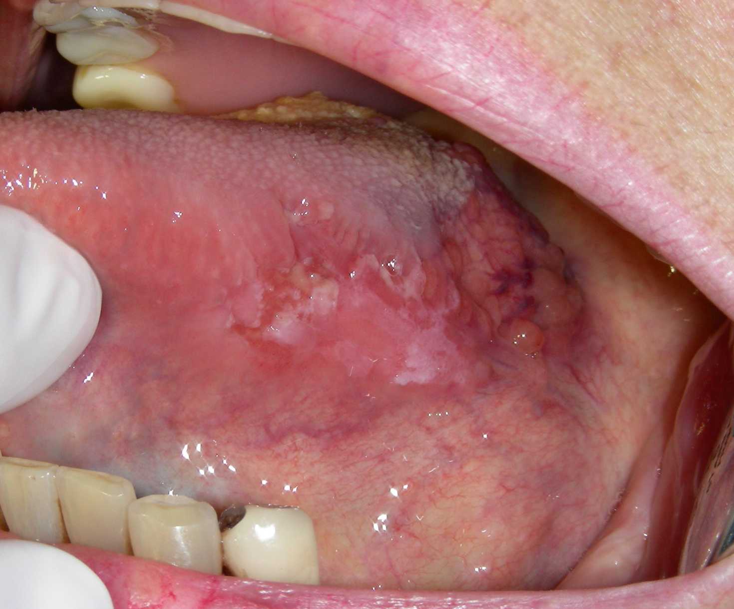 casos-cáncer-oral