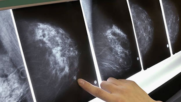 cáncer-de-mama-protonterapia