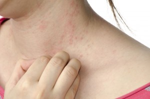 dermatitis-atopica