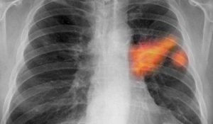 Cáncer-de-pulmón-3