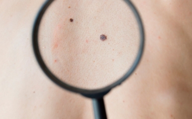 MSD-investigación-prevención-melanoma