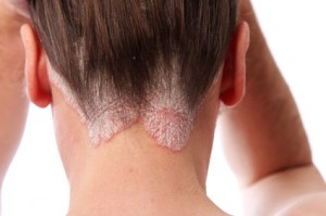 psoriasis-en-placas