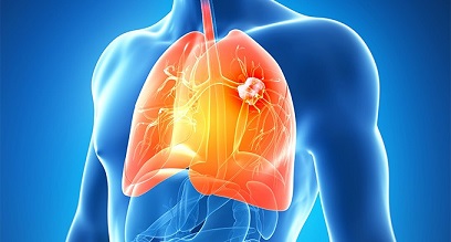 cancer-de-pulmón