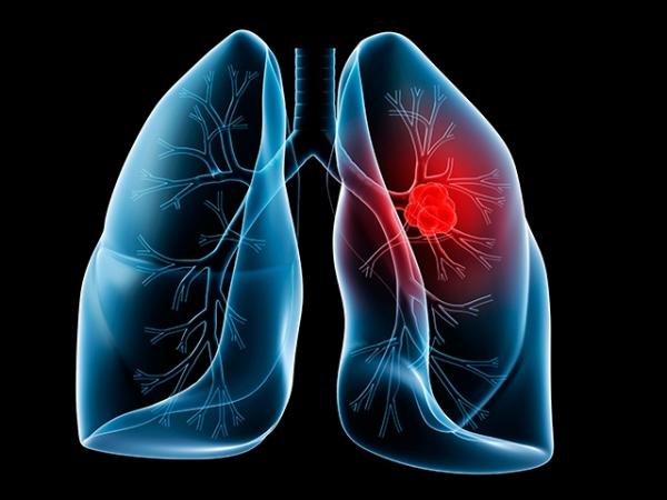 cáncer-pulmón-pembrolizumab