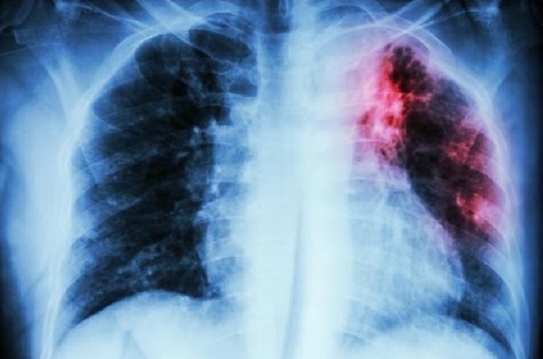 Fibrosis-pulmonar