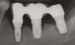 prevención-periimplantitis