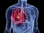 biomarcadores-cáncer-pulmón
