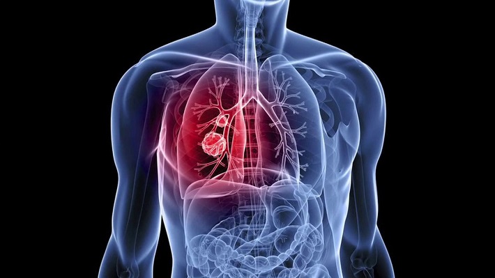 cáncer-pulmón