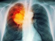 nivolumab-cáncer-pulmón