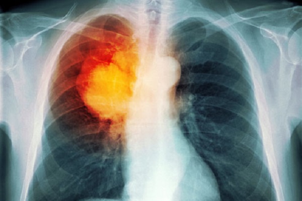 Amivantamab-cáncer- pulmón-avanzado