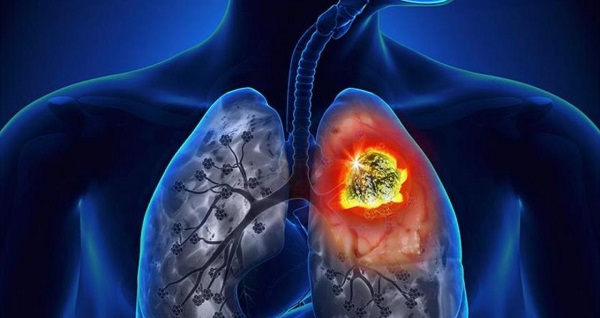 Tratamiento-tepotinib-en-cáncer-de-pulmón