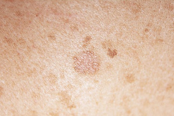 melanoma-cutáneo