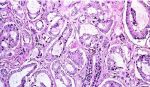 recaídas-de-cáncer-de-próstata