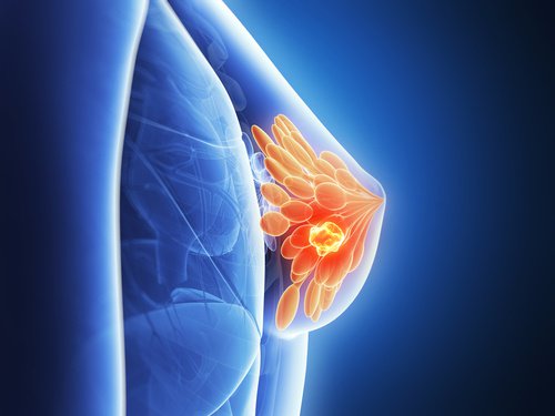 cáncer-de-mama-radioterapia