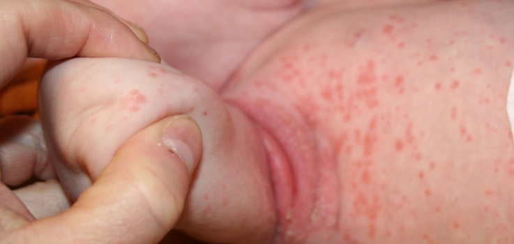 La dermatitis atópica alcanza ya al de la población - iSanidad
