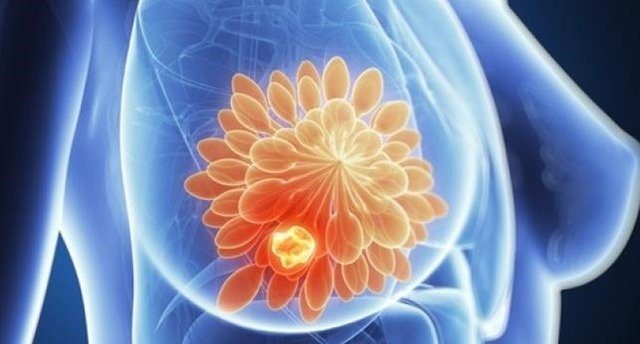 cáncer-de-mama-quimioterapia