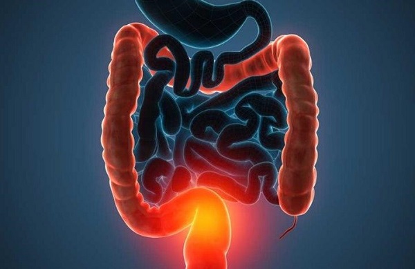 Tumori pe colon Cancer de colon galopante