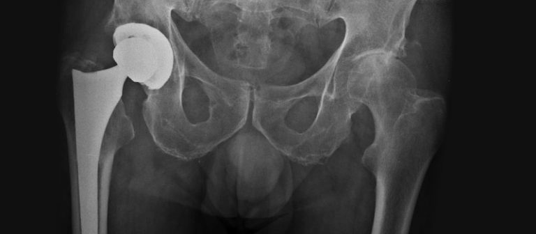 femoroplastias-prótesis- cadera