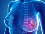cáncer-mama-metastásico-progresión