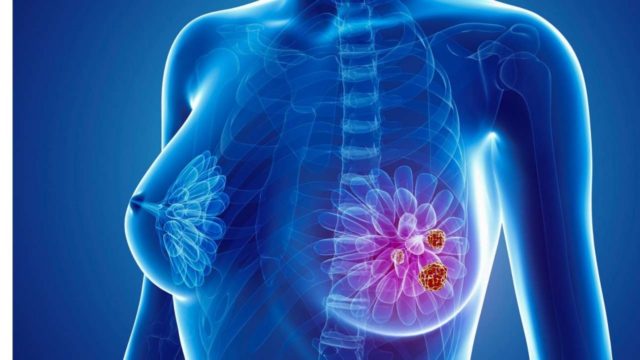 cáncer-mama-metastásico-progresión