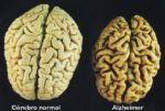 lecanemab-cerebro-estudio