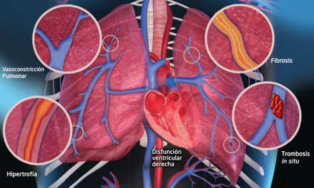 EdúcaTre-hipertensión-arterial-pulmonar