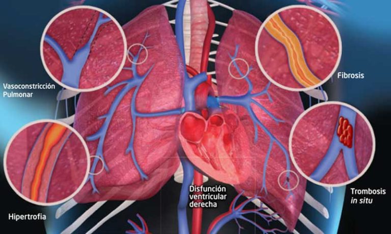 hipertension-arterial-pulmonar