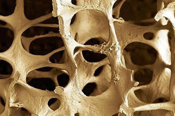 abordaje-osteoporosis