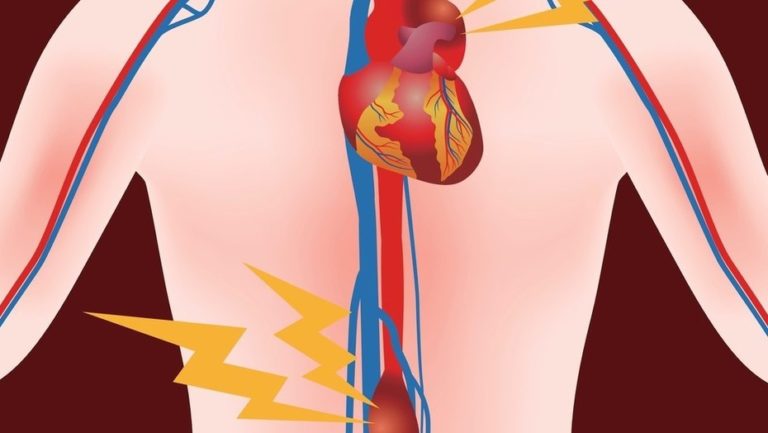 aneurisma-aortico-abdominal