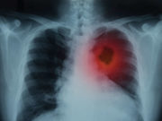cribado-cáncer-de-pulmón