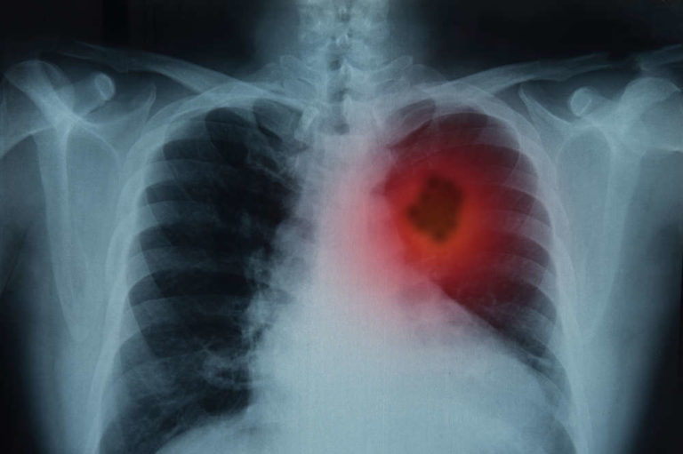 fármacos-cáncer-pulmón