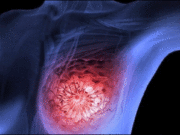 ribociclib-cáncer-mama-avanzado