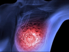 tucatinib-en-cáncer-de-mama