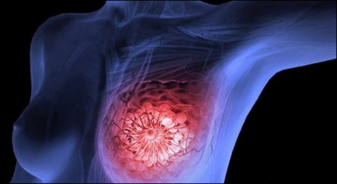 ribociclib-cáncer-mama-avanzado