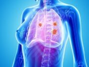brigatinib-cáncer-pulmón