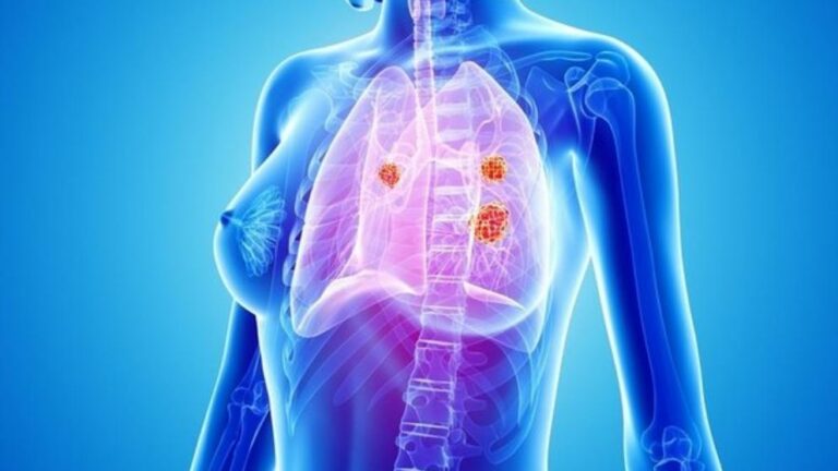 brigatinib-cáncer-pulmón