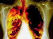 alectinib-cancer-de-pulmon-terapia protones