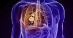 cáncer-de-pulmón-tislelizumab
