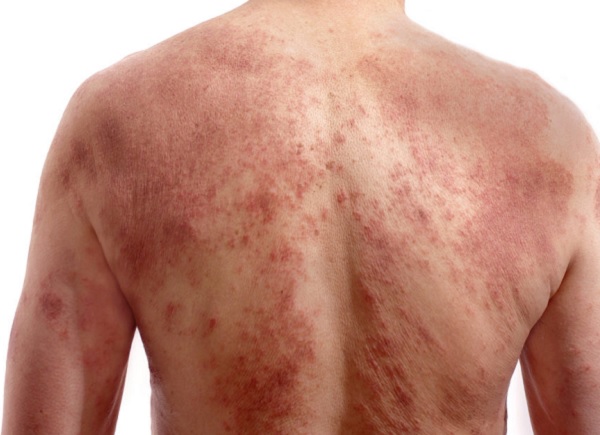 Más de un tercio de los adultos con dermatitis atópica tiene dificultades para lidiar con síntomas