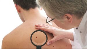 melanoma-omomyc