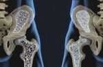 fractura-osteoporosis